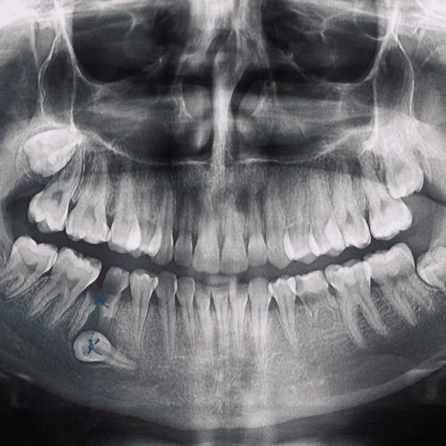 dental radyoloji bdd