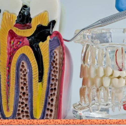 kanal tedavisi bdd e1766865570582